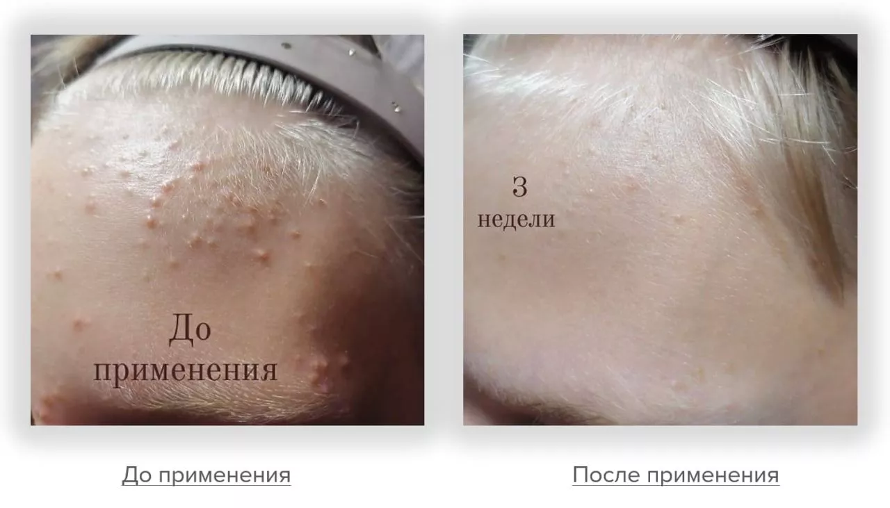 Сыворотка с ниацинамидом 5% "Sebo Control". Niacinamide Serum 5%