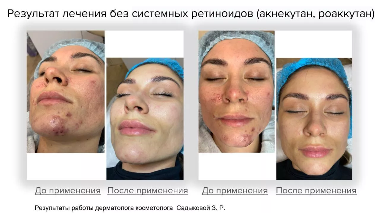 Мягкий очищающий гель Gentle Cleanser Free From Malassezia
