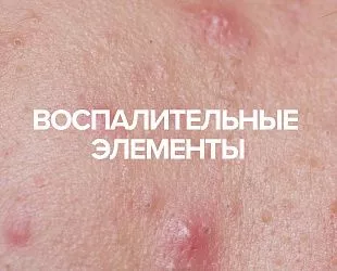 Комплексное решение для акне с воспалительными элементами