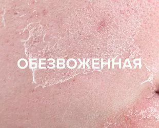 Комплексное решение для обезвоженной кожи с нарушенным барьером